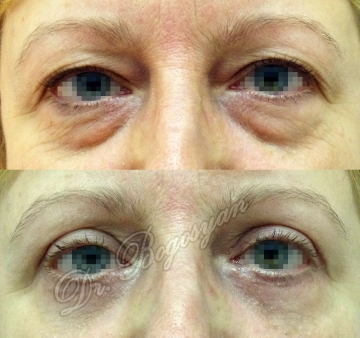 Блефаропластика верхних и нижних век
