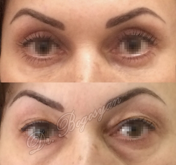 Блефаропластика верхних и нижних век