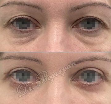 Блефаропластика верхних и нижних век