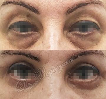 Блефаропластика верхних и нижних век