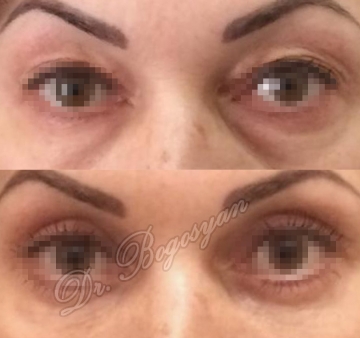 Блефаропластика верхних и нижних век