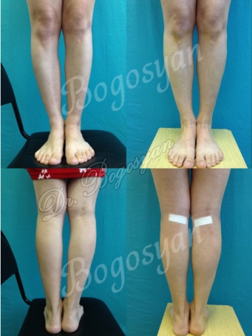 Увеличение голеней (круропластика)