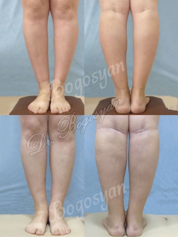 Увеличение голеней (круропластика)