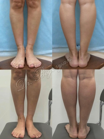 Увеличение голеней (круропластика)