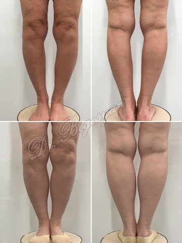 Увеличение голеней (круропластика)