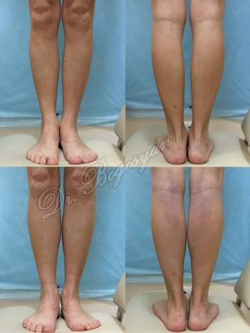 Увеличение голеней (круропластика)