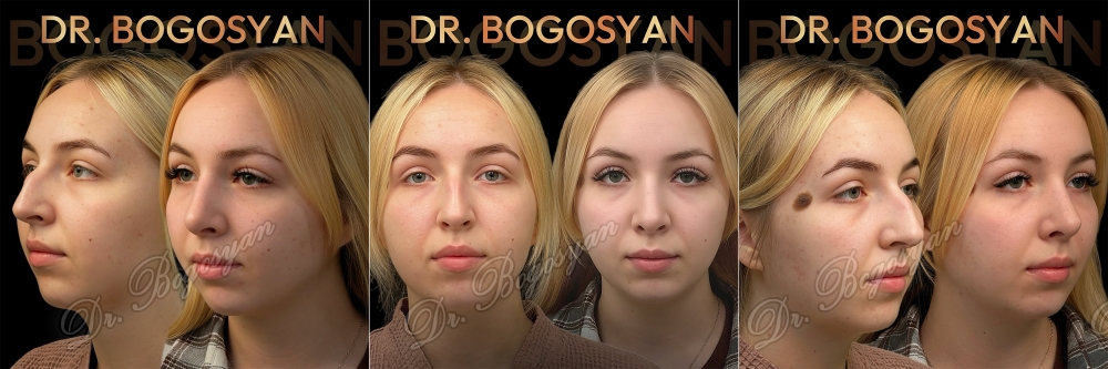 Ринопластика (пластика носа)