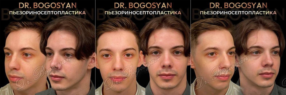 Ринопластика (пластика носа)