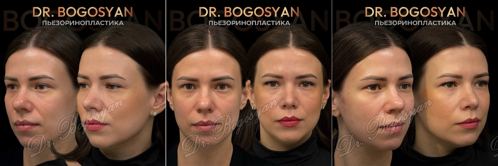 Ринопластика (пластика носа)