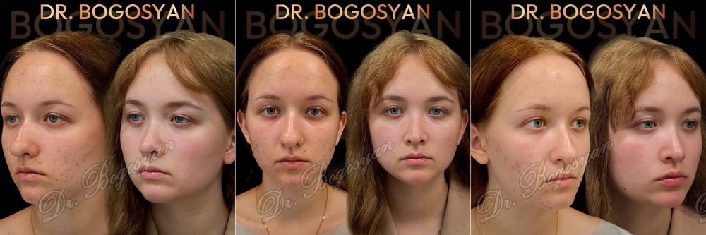 Ринопластика (пластика носа)