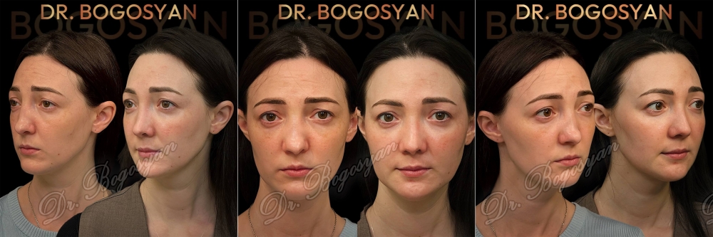 Ринопластика (пластика носа)