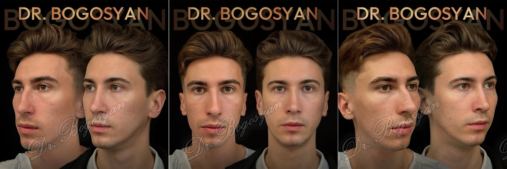 Ринопластика (пластика носа)