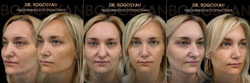 Ринопластика (пластика носа)