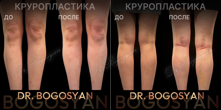 Увеличение голеней (круропластика)