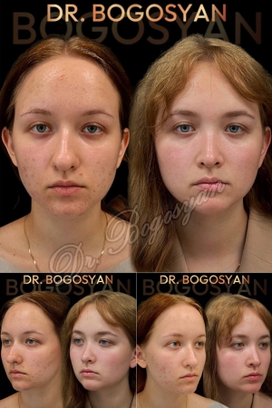 Ринопластика (пластика носа)