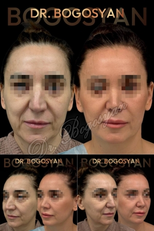 Ринопластика (пластика носа)